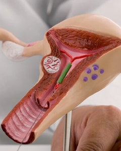  Dilation and Curettage