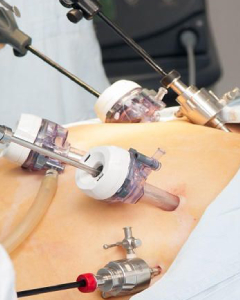  Gynecology surgeries ( Fibroid removal, Ovarian Cyst, Hysterectomy) 