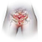 Ovarian cyst